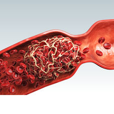Ani gelişen arteriyel kan akımı kesilmesi → distal dokularda iskemi.