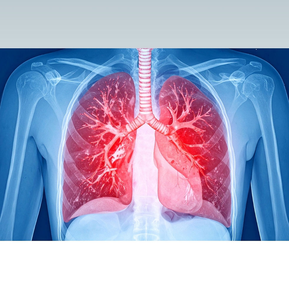Pulmoner hipertansiyon (PH): Pulmoner arter basıncının kalıcı yüksekliği (≥20 mmHg, sağ kalp kateterizasyonu ile).