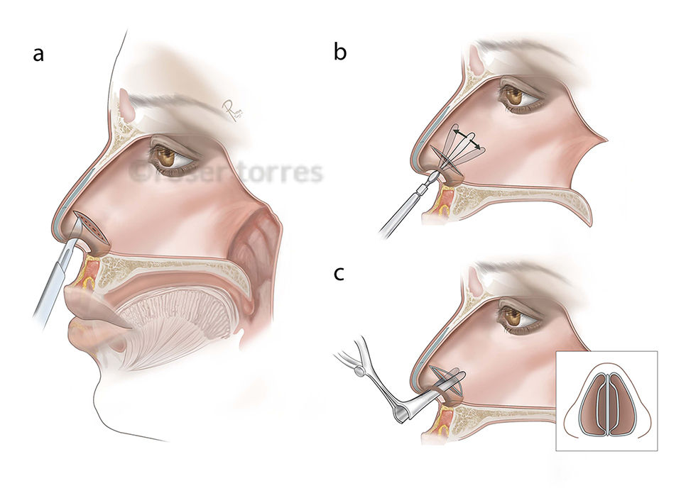 rhinoplasty