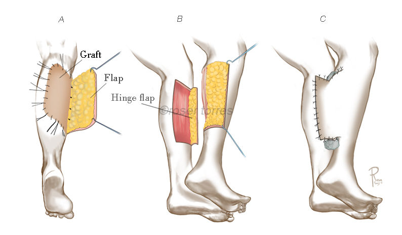 flaps legs Roser Torres