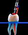 root canal