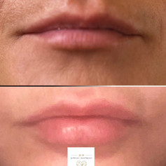 LIP FILLER