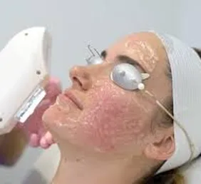 IPL Photo Facial.webp