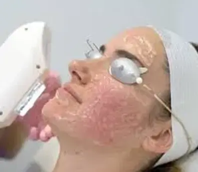 IPL Photo Facial.webp