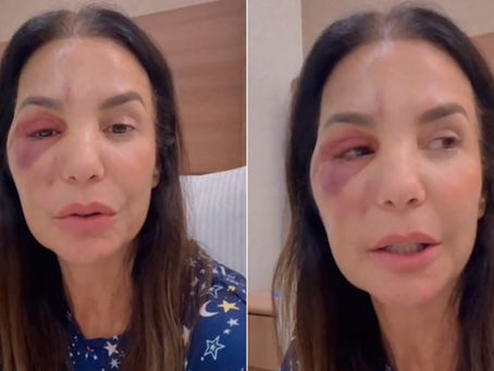 Ivete Sangalo passa por cirurgia após queda e tranquiliza fãs