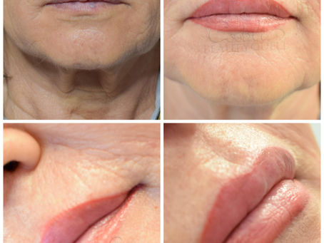 Lippenkorrektur, Lippenfarbkorrektur - jünger aussehen!