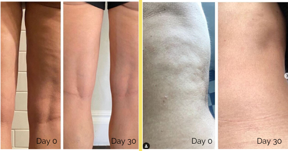 Thumbnail: Skinade Targeted Solutions Cellulite 30 Days