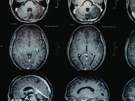 Does Acupuncture Really Work? What the Science Says