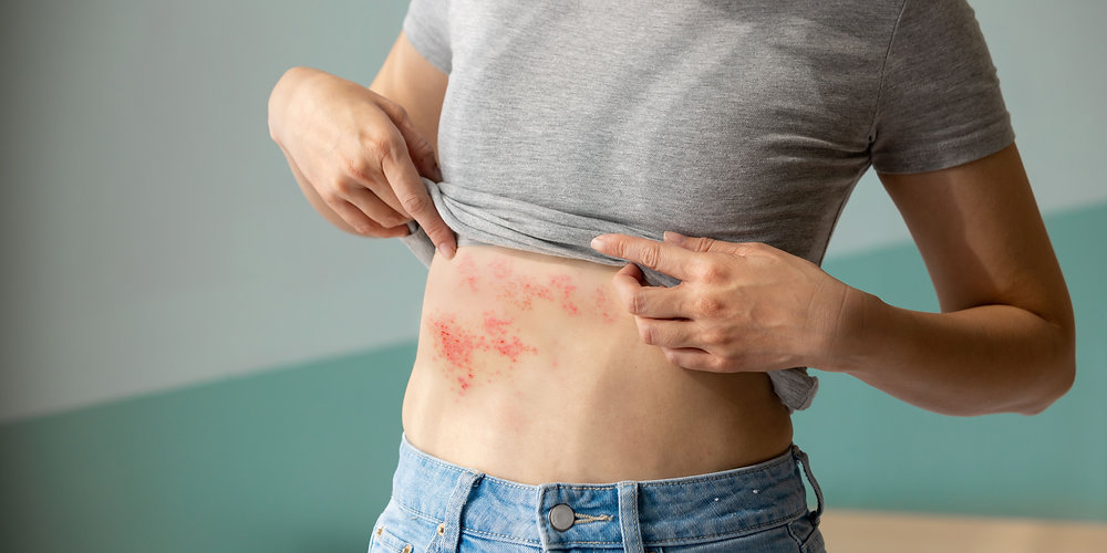 Treating Shingles Pain with Acupuncture