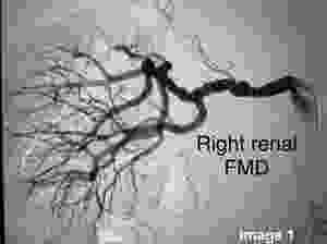 Right Renal Angiography