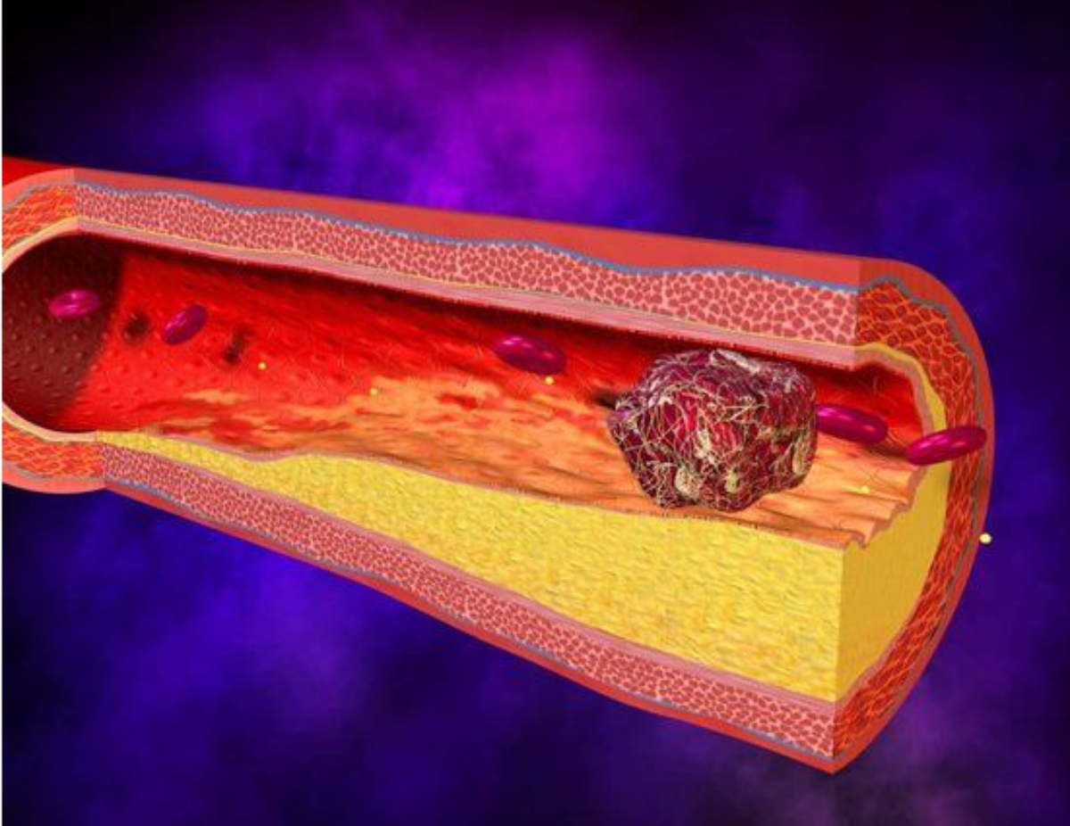 how to stop bleeding while on blood thinners how to stop bleeding while on blood thinners