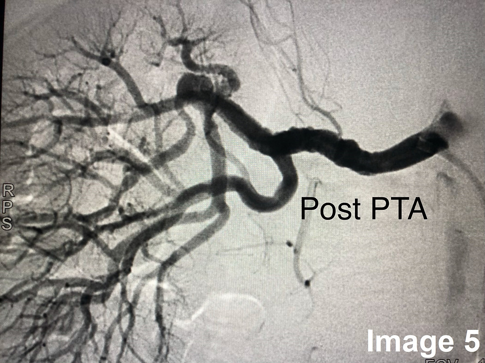 Post PTA Angiography