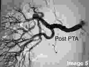 Post PTA Angiography