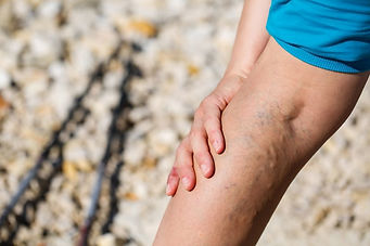 venous-insufficiency.jpg