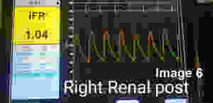 Right Renal FFR post PTA