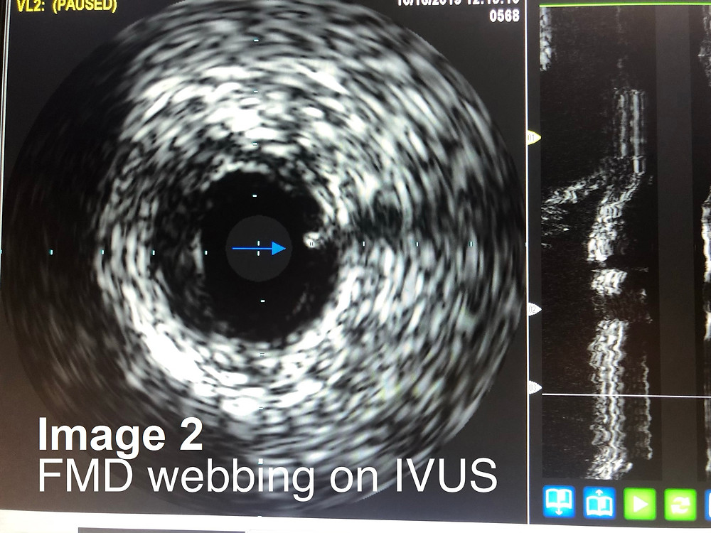 Intravascular Ultrasound (IVUS)