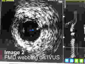 Intravascular Ultrasound (IVUS)