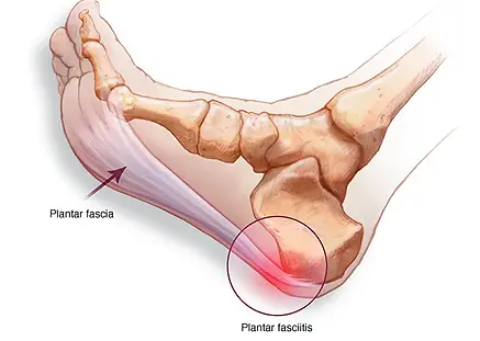 ds00508_im00939_r7_fasciitisthu_jpg.webp