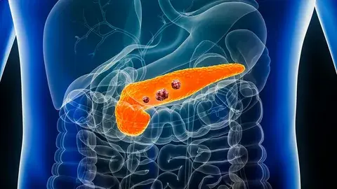 Pancreatic Cancer Market Demand and Outlook 2034