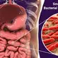 A Breath of Relief: Overcoming Chronic Constipation with SIBO Treatment