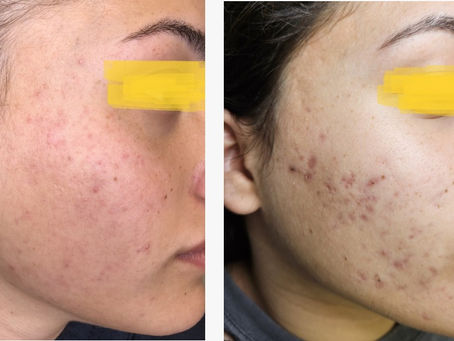 איך נפטרים מאקנה?