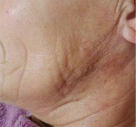 FaceNeck Wrinkles Before.png