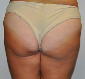 GLUTEUS LOCALIZED FAT AND CELLUKITE B4.p