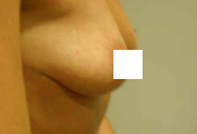 Breast Ptosis After.png
