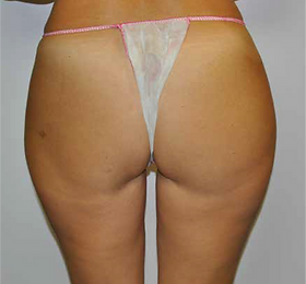 GLUTEUS LAXITY after.png