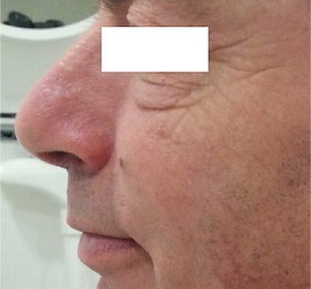 Face Oedema Before.png