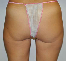 GLUTEUS LAXITY B4.png