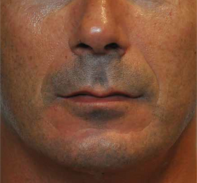 Naso Genial Wrinkle B4.png