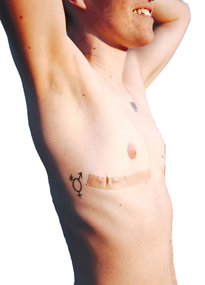 top-surgery-tips-1-67c230d90572a_edited_