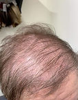 A person with thinning hair.