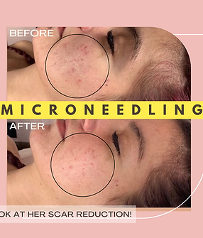 Microneedling