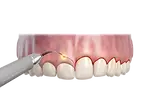 laser gum therapy before and after Concord CA