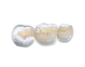 porcelain dental inlay onlay before and after Concord CA