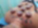 hijama cupping therapy treating irish patient.jpg