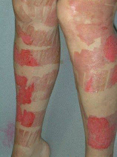 dermatologue bruxelles lumiere-pulsee esthéticienne-probleme.jpeg