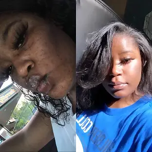 Hyperpigmentation cleared naturally with Milli Cleanse before and after photo