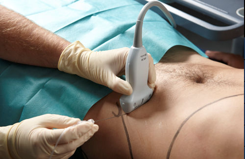 ECOGRAFIA PARED ABDOMINAL