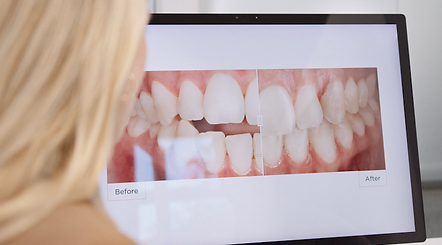 Predictibile (SPARK Aligners) - DCOrto #DCOrto #Spark #Orthodont #teeth #aligners #smile.p