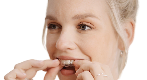 Estetice 4 (SPARK Aligners) - DCOrto #DCOrto #Spark #Orthodont #teeth #aligners #smile.png