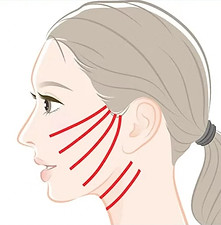 Thread lift