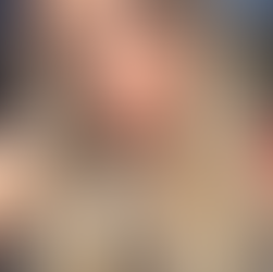 Dicas de Fernanda Almeida - Melasma e o laser Spectra Toning