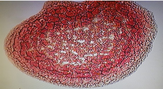 Dry Blood Analysis