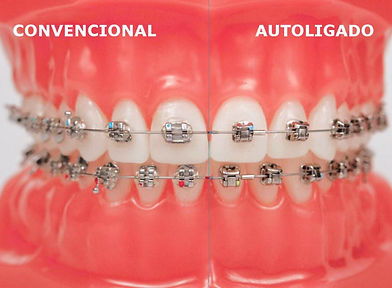 Aparatología convencional de ortodoncia. Brakets y de autoligado