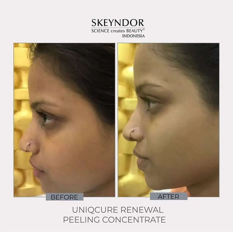 Miniatura: Skeyndor UNIQCURE – Renewal Peeling Concentrado - 1 ampola 2ml