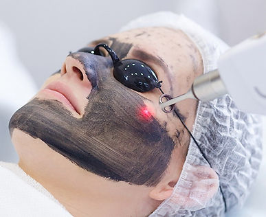 Carbon Peel Fredericton.jpg