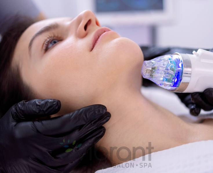 How Long Does RF Microneedling Last